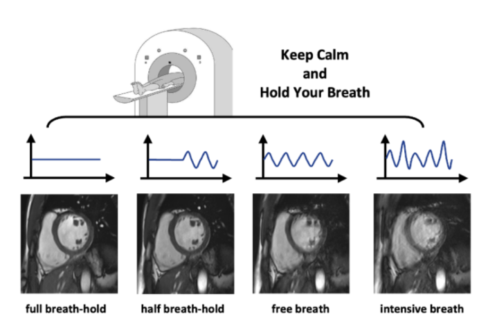 呼吸运动伪影的图像质量评估
